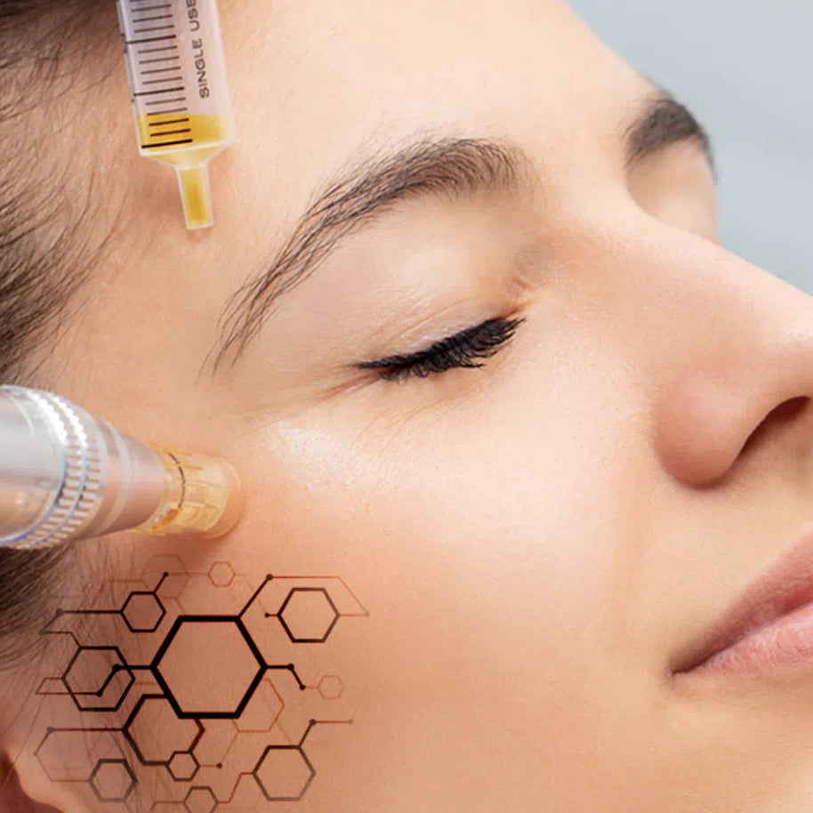 EXOSOMAS CON MICROAGUJAS + PEELING