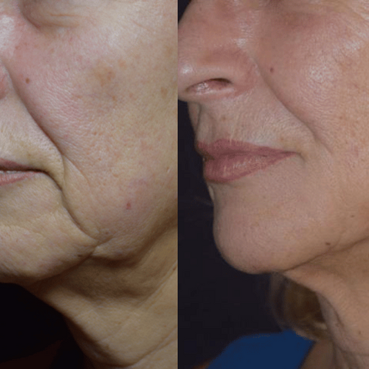 ROSTRO, PAPADA Y ESCOTE