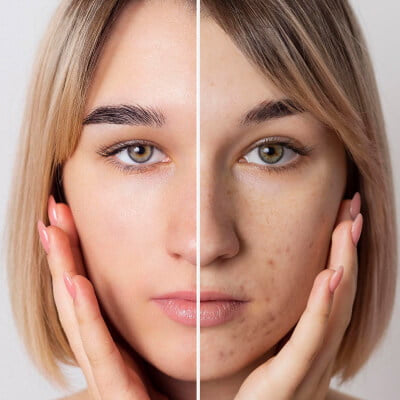 ADVANCED LIGHTENING PEEL